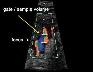 Színkódolt Doppler képalkotás előnyei Ereződés megítélése mellett a
