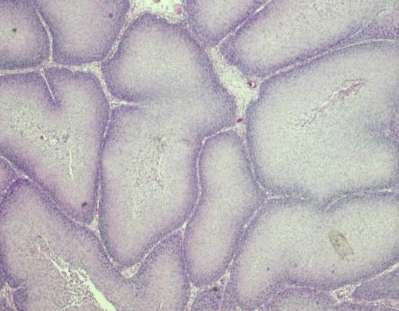 Laphámcarcinoma