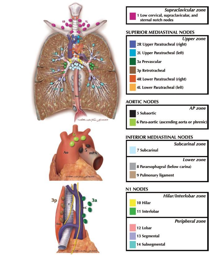 N kategória Az érintett nyirokcsomó lokalizációja számít N1 - azonos oldali peribronchialis, hílusi és intrapulmonalis N2 azonos oldali mediastinalis, subcarinalis