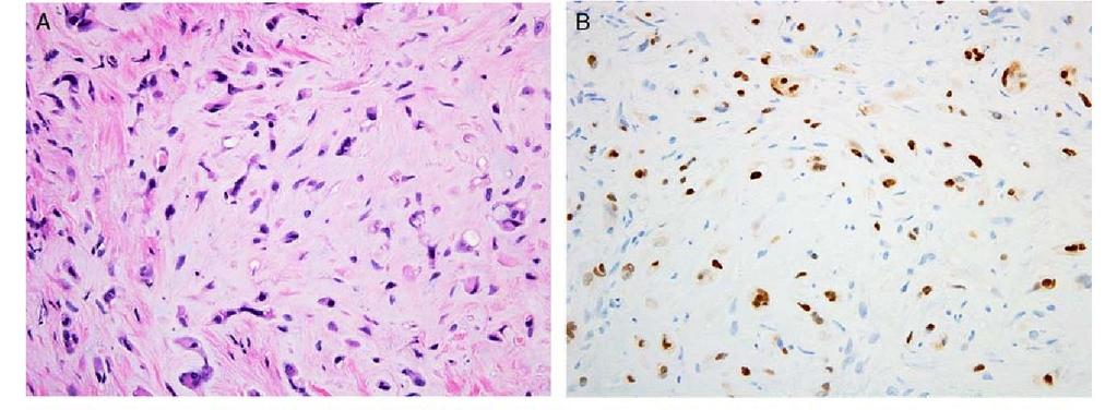 transzkripciós faktor Epithelioid angiosarcomában nincsenek ezek a fúziós