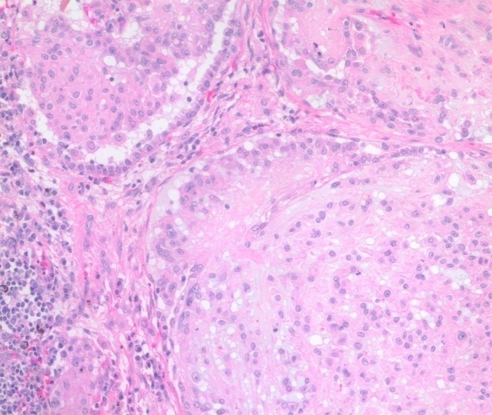 Epithelioid hemangioendothelioma Epithelioid angiosarcoma Növekedési mintázat Nodularis, intraalveolaris Diffúz, infiltráló Stroma Myxo-hyalin, chondroid Hemorrhagiás Perivasculáris