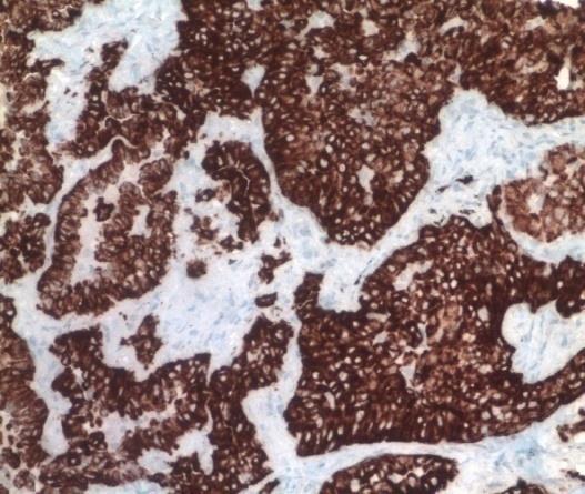 ALK inhibitor (crizotinib) terápiára reagál A kimutatás lehetőségei: RT-PCR (friss minta), szekvenálás FISH (gold standard, legalább 50-100 sejt