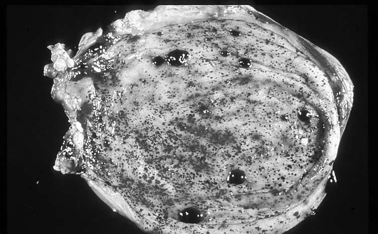 Vérzéses urocystitis,