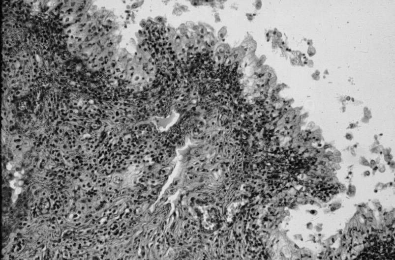 Haemorrhagic-purulent cystitis
