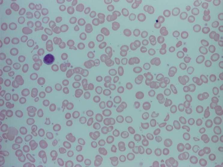 Vas depleció (kimerülés) a szervezetben diagnózisa-haematológia Peripheral blood smear of a patient with severe iron deficient anaemia.