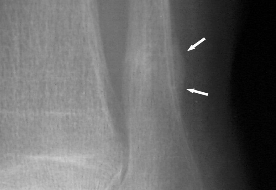 Stress Fractura Rizikó faktorok: Csontállomány, (mestruációs zavarok, amenorrhea min.