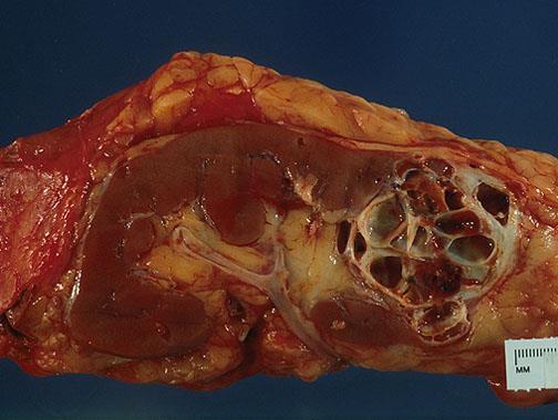 MULTILOCULAR CYSTIC