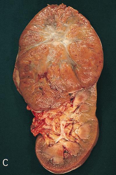 ONCOCYTOMA
