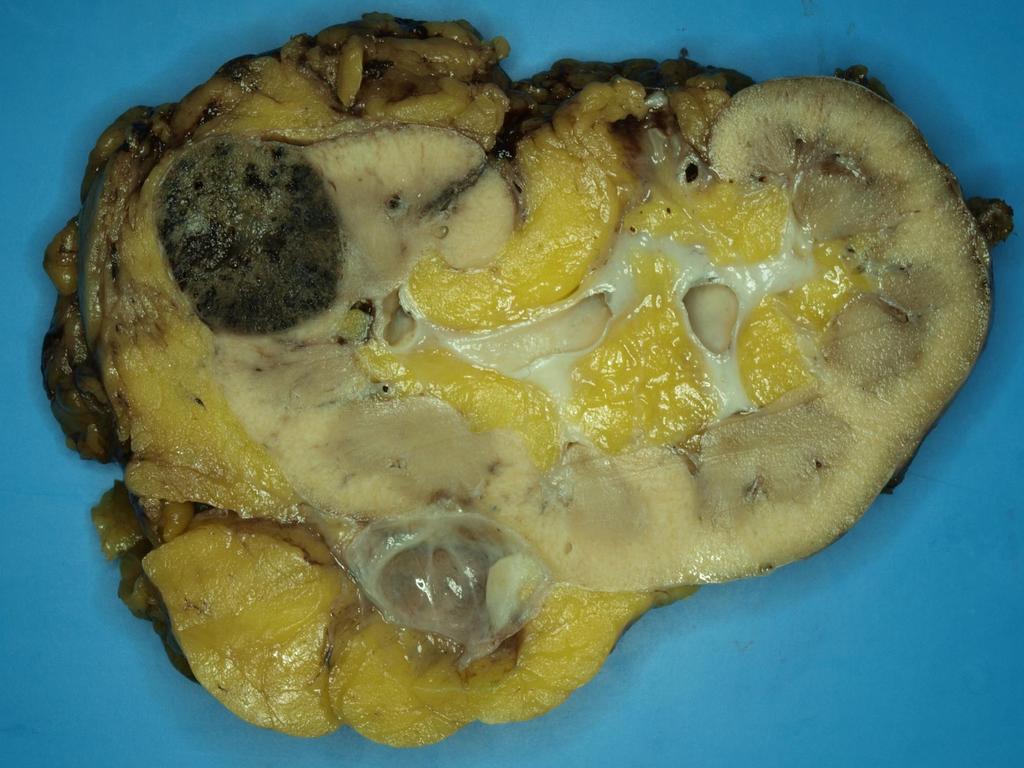 ONCOCYTOMA