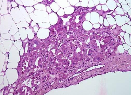 ONCOCYTOMA