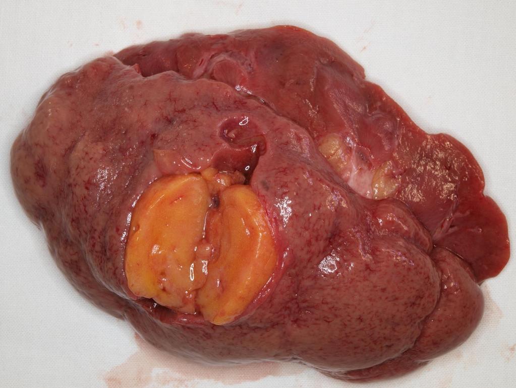 LIPOMA
