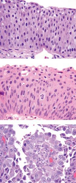 PAPILLARY UROTHELIAL NEOPLASM OF LOW MALIGNANT POTENTIAL