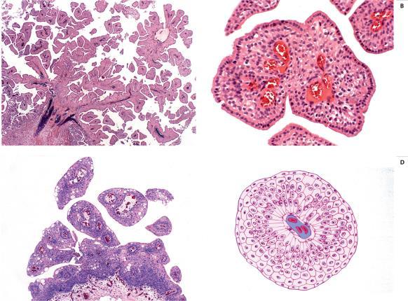 PAPILLOMA
