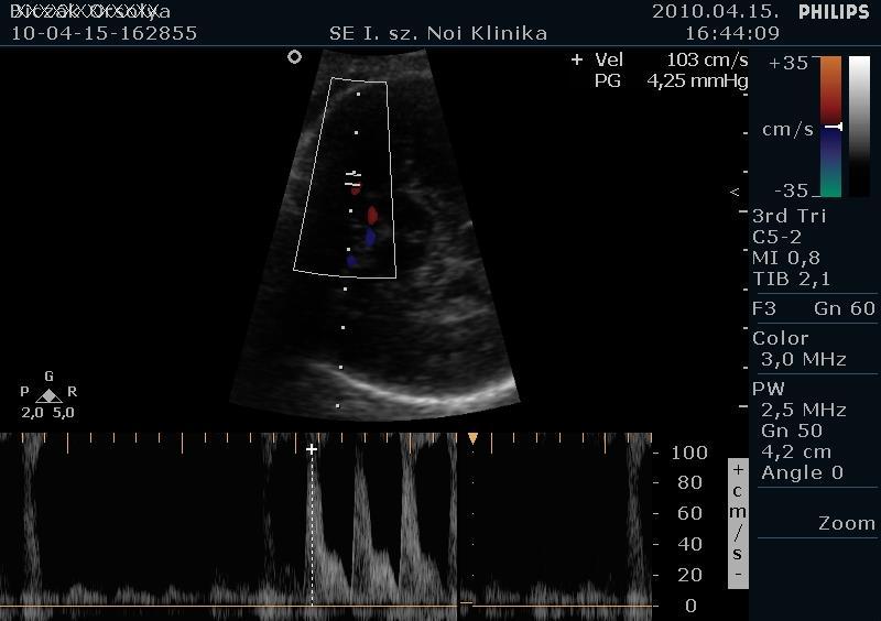 A pulzatilis Doppler és az arteria cerebri media iránya egyező, a