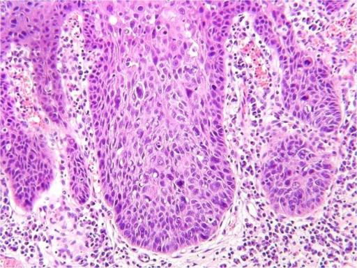 Szövettani vizsgálat (grading) incíziós/excíziós biopszia, fagy.