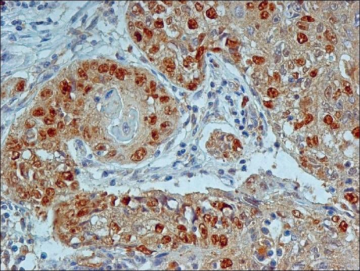 neg. FTAB esetén ismételni (cysicus met. HPV) pontosabb N státusz (álpoz./álneg.