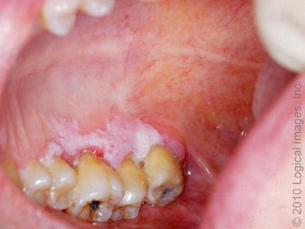 malignus rendellenességek (OPMD, precancerosisok) Leukoplakia Önmagában