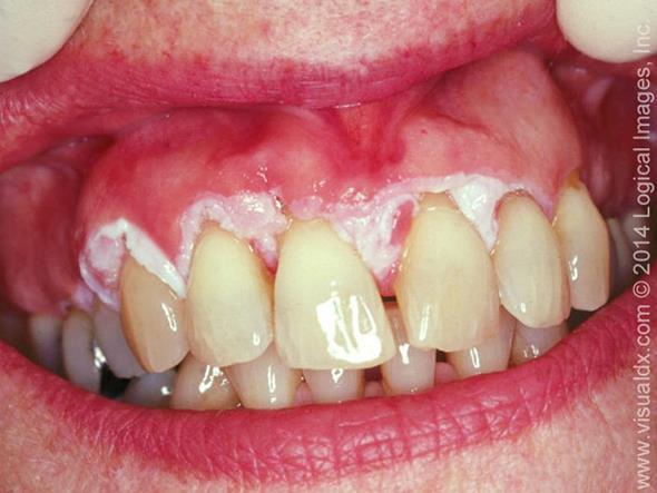 gyulladás, +/-dysplasia) Th: excisio, laser ablatio, fényterápia (5- ALA), konz.