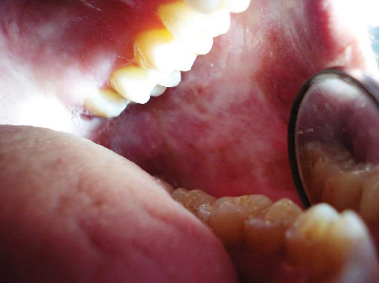 biopsia (dysplasia, CIS, invazív SCC) Th: sebészi kimetszés, recidíva a lézió méretével arányos Orális