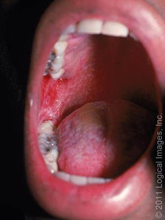 Modulátorok Oralis discoid lupus erythematosus Oralis chronicus graft-versushost