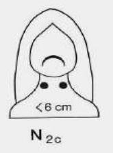 3cm, ENE- N2 N2a egy ipsilateralis 6cm nycs.