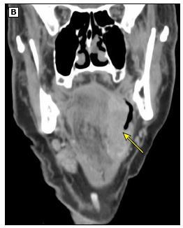 vizsgálat, mint az MR optimálisan 3 mm felbontás + információ: preepiglottikus, paraglottikus tér, subglottikus