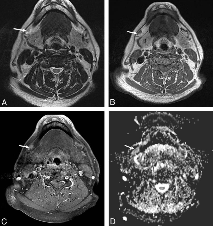 Képalkotó vizsgálatok MRI jobb lágyrész felbontás, mint a CT, különösen a koponyaalapon (NCCN ajánlás) 3-5 mm-es rétegvastagság felszínesebb
