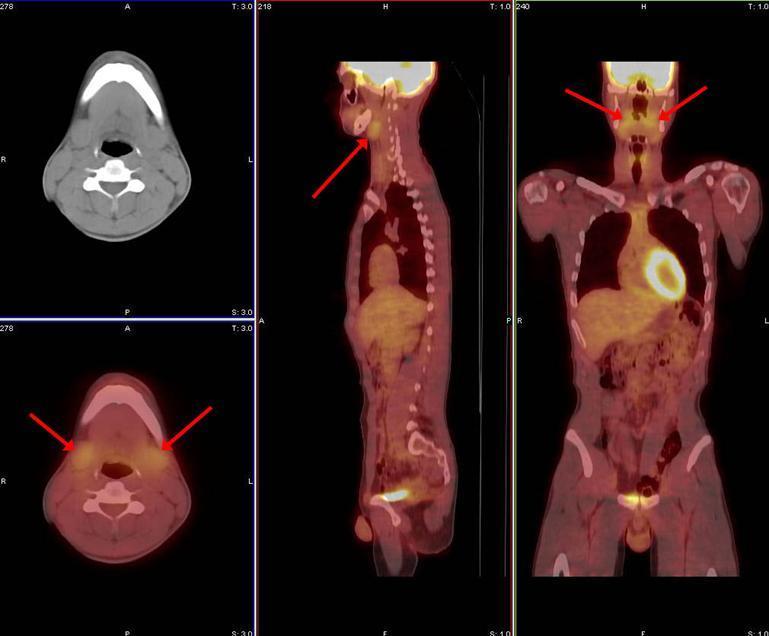 Képalkotó vizsgálatok PET/CT pozitron emittáló radionuclid [ 18 F]FDG szoftveresen