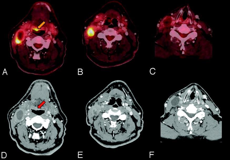 CT vizsgálat javítja a felbontást primér tumor esetén azonos szenzitivitás/specificitás