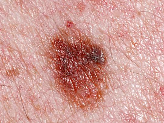 melanoma