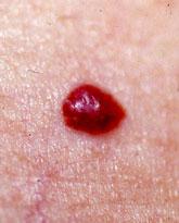 angioma