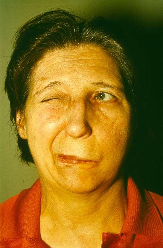 Átmeneti faciális parézis a bal