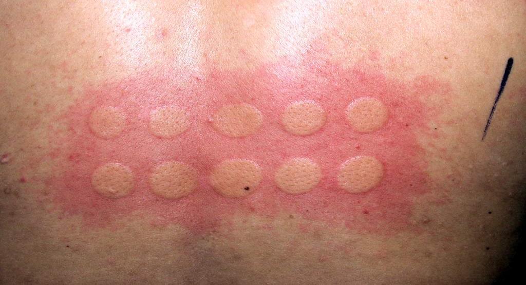 Urticaria e solare, urticaria solaris, fény-urticaria Diagnózis: fototesztek: UVC, UVB, UVA