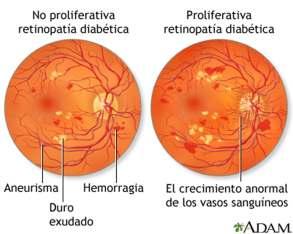 Retinopathia diabetica A munkaképes korú lakosság látásvesztésének vezető oka.