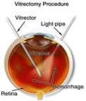 Retinopathia diabetica Az enyhe diabéteszes retinopátia nem feltétlenül okoz látáspanaszt!