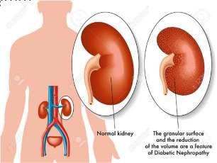 Nephropathia diabetica Hypertonia, GFR fokozatos csökkenése, mikroalbuminuria 30-300mg/nap A diabeteses nephropathia (DNP) ma a végstádiumú veseelégtelenség vezető oka.