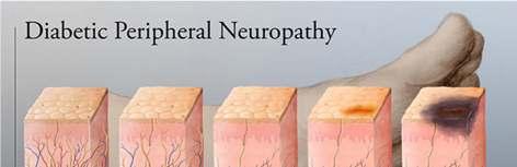 Neuropathia diabetica A diabeteses neuropathia a (poly)neuropathiák leggyakoribb formája.