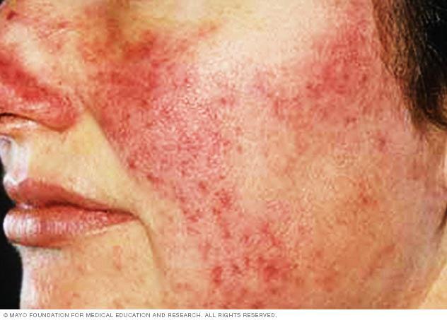 Rosacea