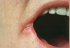 hiányállapotok (B2, B6 vitamin) Allergizáló faktorok Hajlamosító