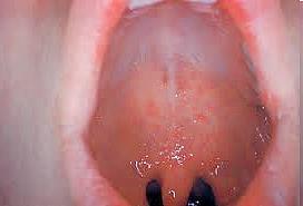 gyógyul Ritkán: myocarditis,