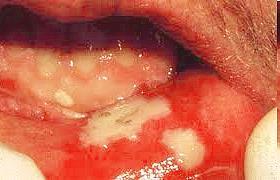 Helyi védekezés tényezői: Stomatitis alacsony