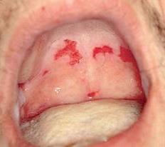 pemphigus