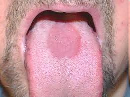 glossitis