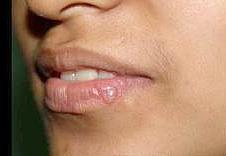Herpes