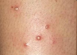 Bacterialis