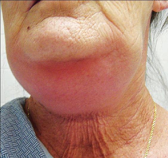 Ludwig-angina (angina ludovici)