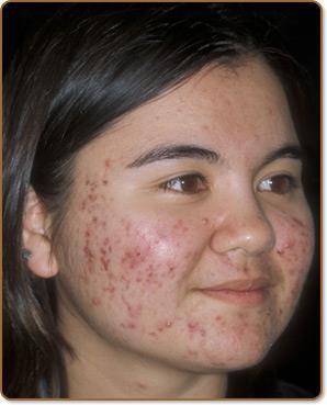 Acne vulgaris Pubertás tesztoszteron
