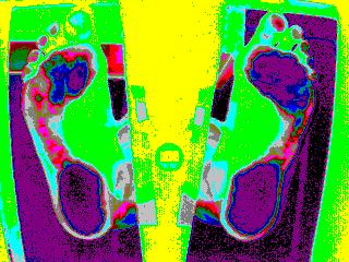 Valgus