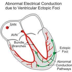 Mechnisms of Arrhythmogenesis 1- Abnormal