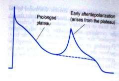 Triggered rhythms Enhanced normal